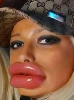 botox-lips.jpg