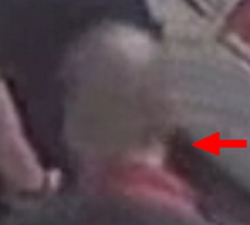 Zimmerman_injury.jpg