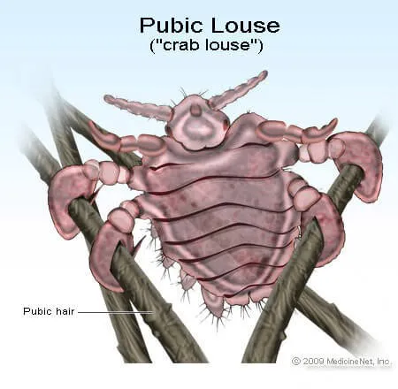 pubic_louse.jpg